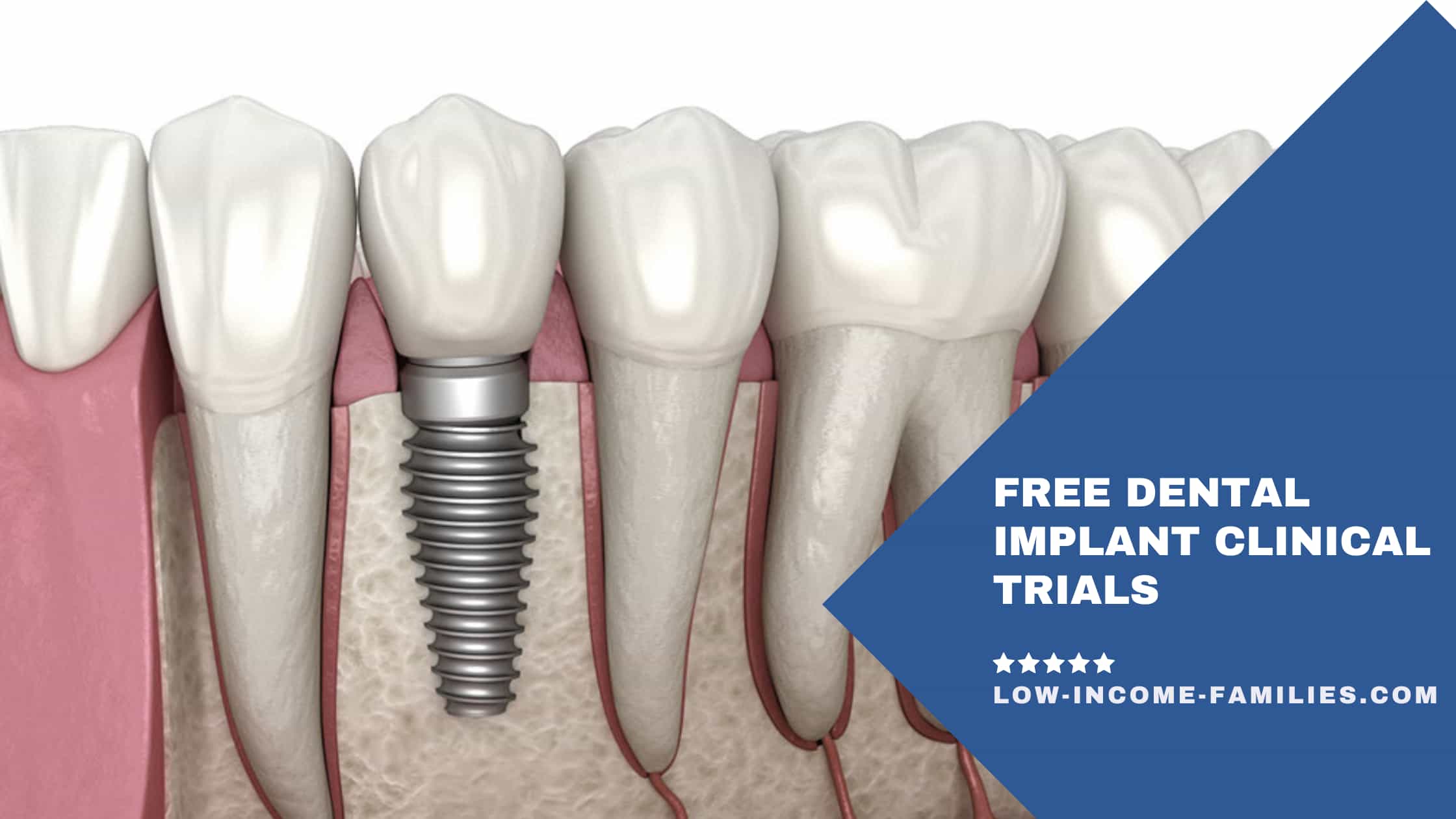 Free Dental Implant Clinical Trials