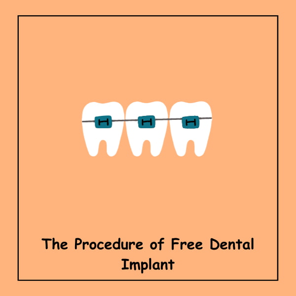 The Procedure of Free Dental Implant